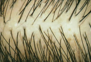 Esempio di capelli diradati prima del trattamento con Folicerin