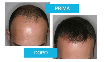 Risultati visibili del trattamento Profolan per capelli