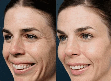 Foto di una recensione che mostra i risultati dopo l'uso della Crema ELLESSE