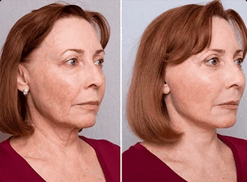 Immagine di una cliente soddisfatta che mostra l'efficacia della Crema ELLESSE