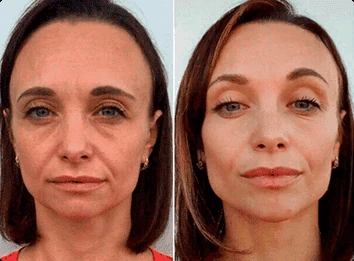 Testimonianza visiva dei benefici della Crema ELLESSE sulla pelle