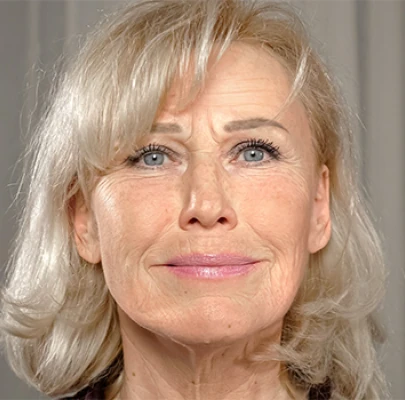 Immagine di una donna prima del trattamento Retilift