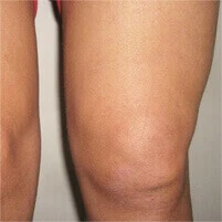 Immagine rappresentativa della sinovite